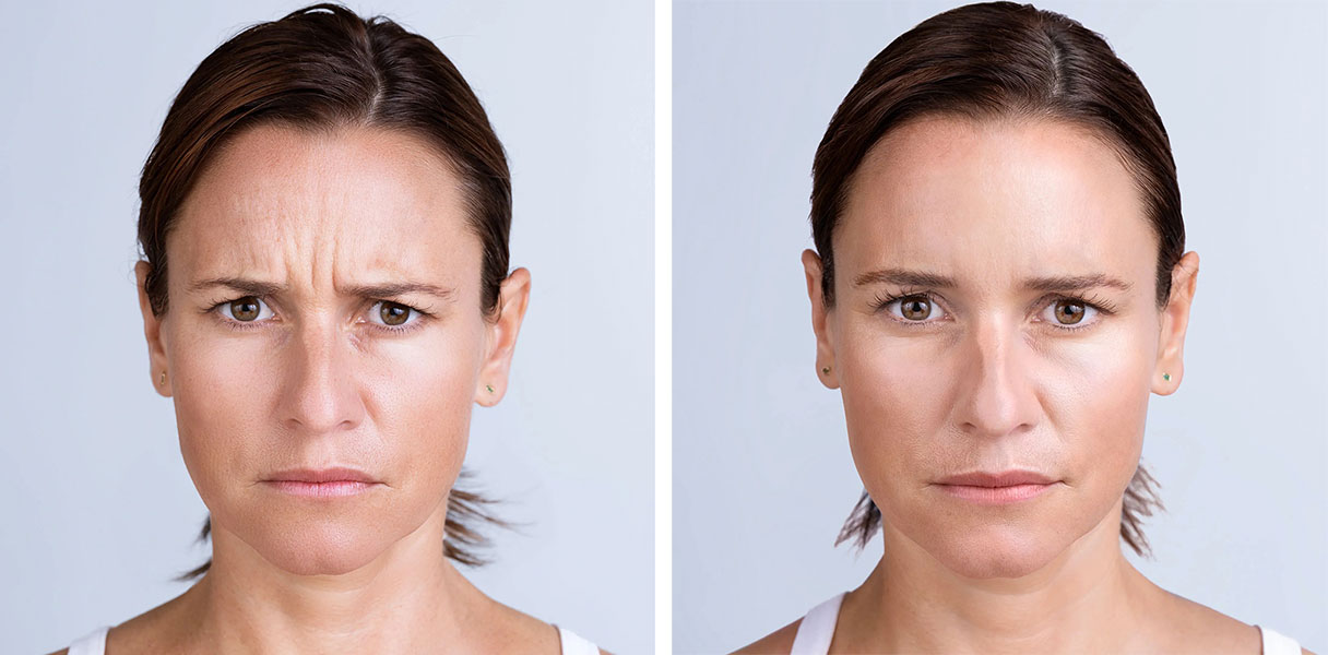reduce frown lines with injections in Vancouver