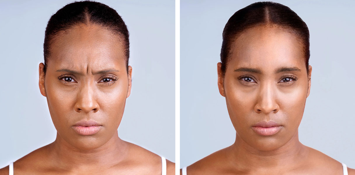 esthetic clinic for wrinkle removal in Vancouver