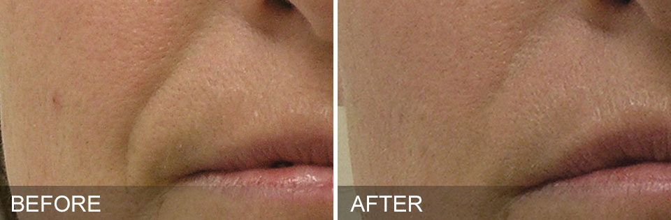 Injections to get rid of frown lines in vancouver