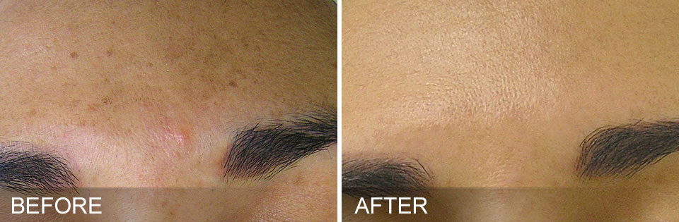 fresh face no acne with treatment in vancouver