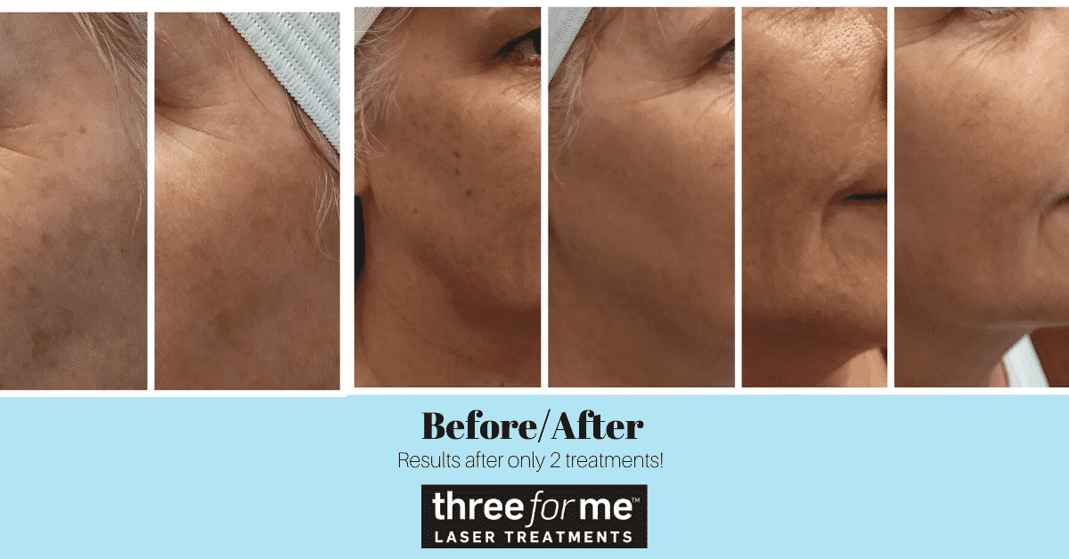 threeforme laser treatment to reduce blemishes in british columbia