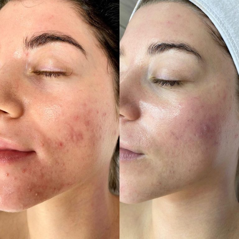 reduce the look of acne and pimples in vancouver