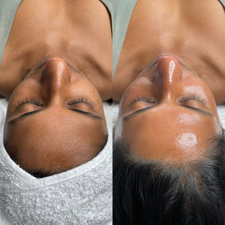 rejuvenate your skin in west vancouver