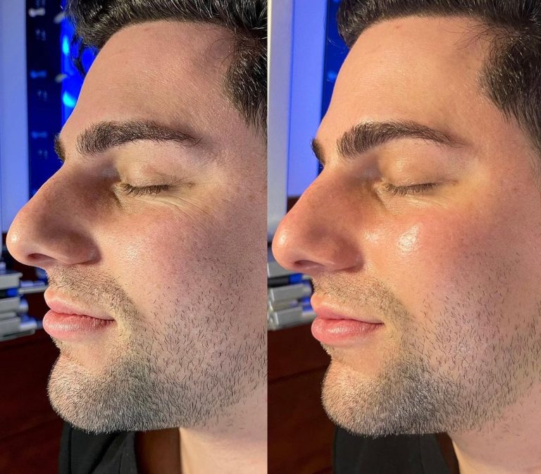 wrinkle reduction in west vancouver
