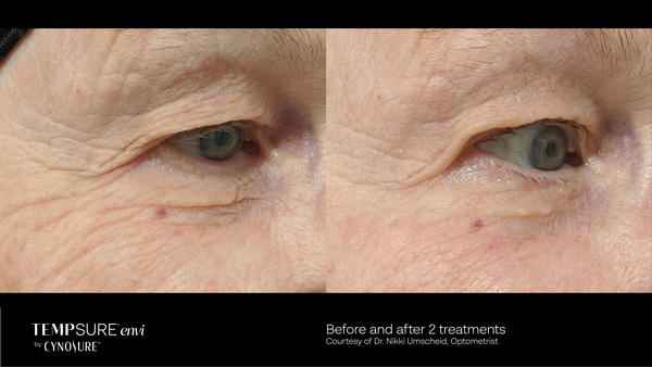 reduce wrinkles and fine lines with tempsure envi in vancouver