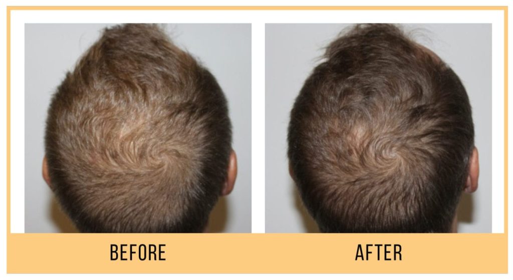 before and after scalp & hair rejuvenation in vancouver
