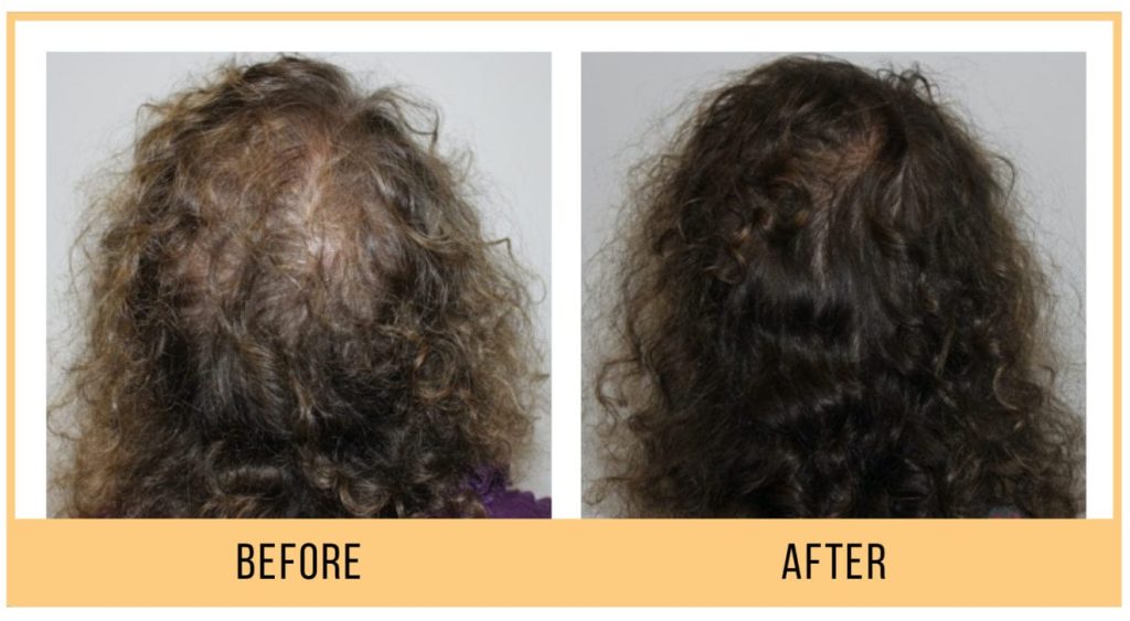 keravive for scalp & hair rejuvenation in vancouver