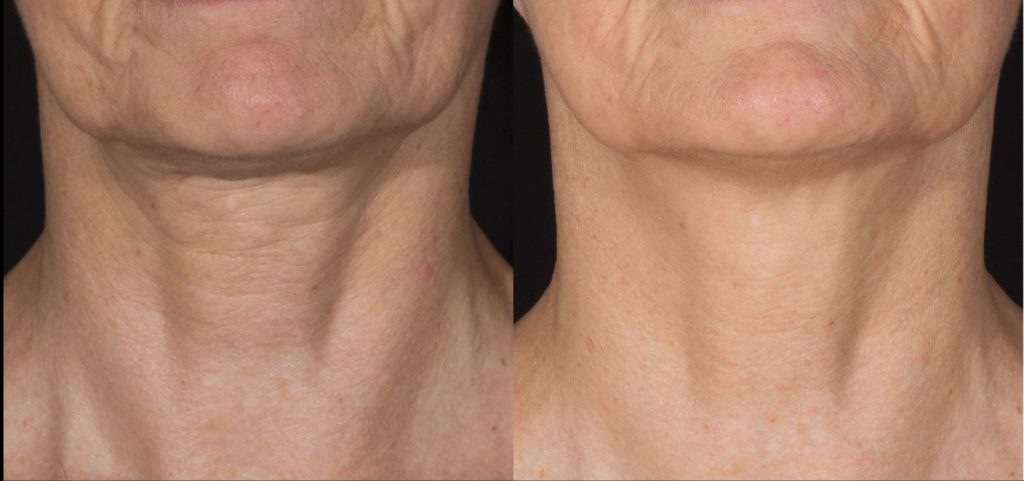 microneedling for skin tightening with potenza rf in north shore