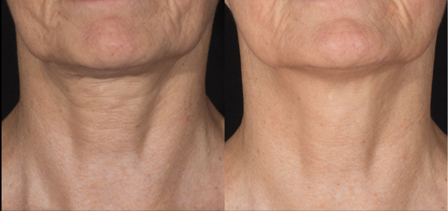 microneedling for skin tightening with potenza rf in north shore