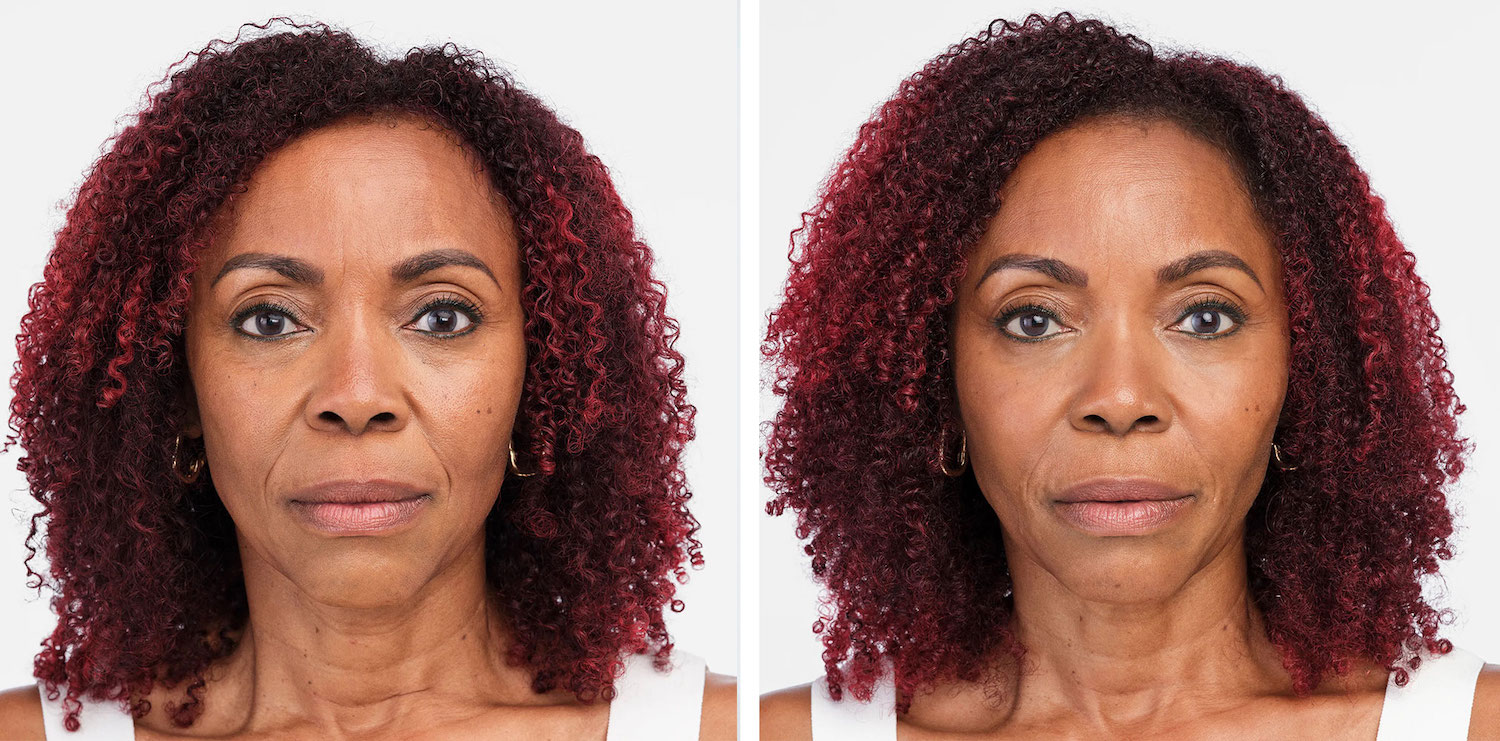 radiesse for facial fillers in vancouver