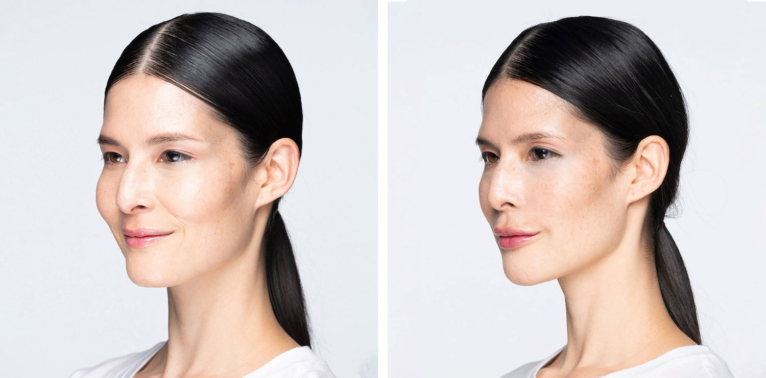revanesse for facial fillers in vancouver