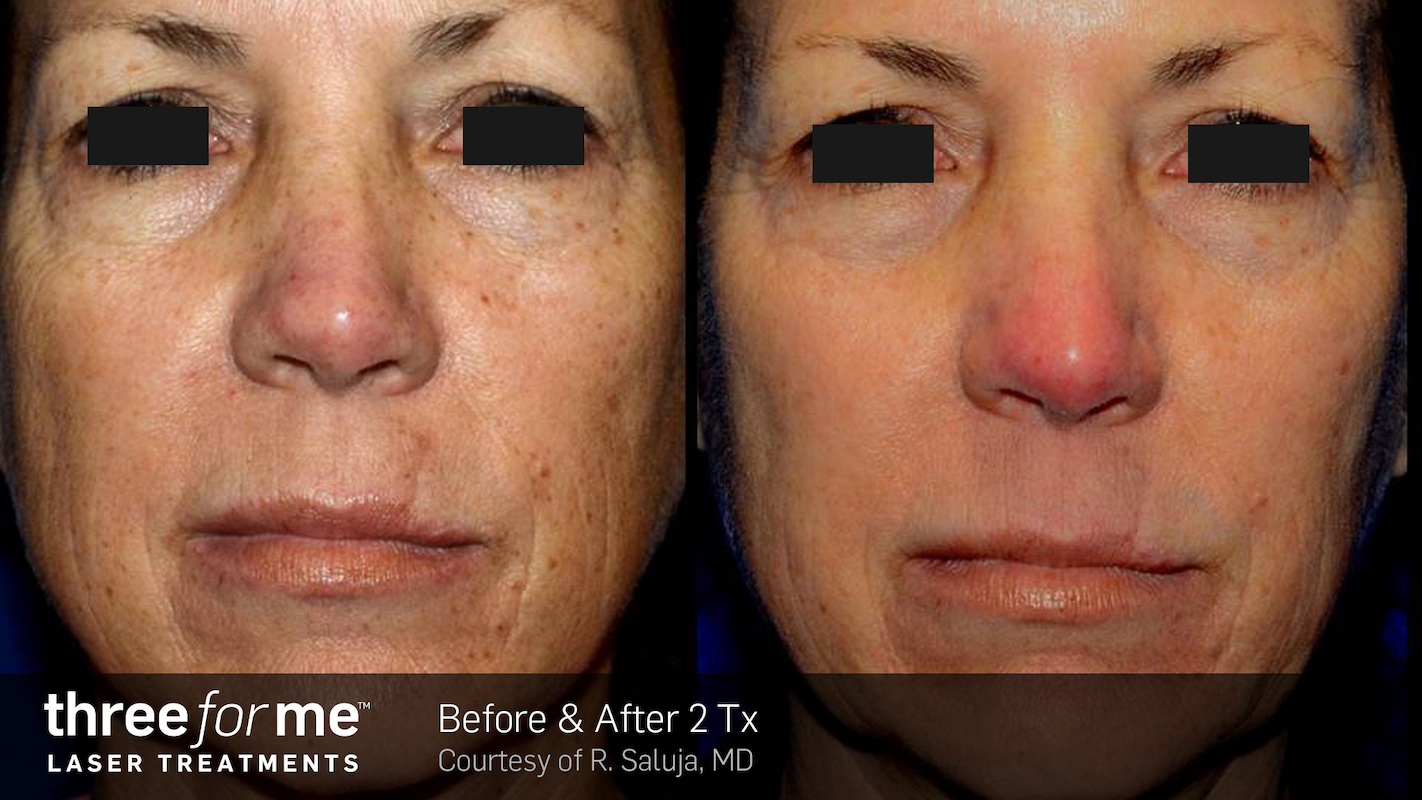 repair wrinkles and sun damage with threeforme laser in vancouver