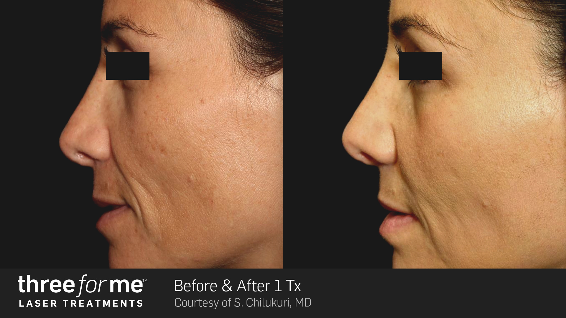 three for me laser treatments for smoother skin in vancouver