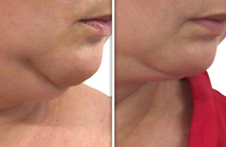 anti-aging fibroblast facial LPG in british columbia