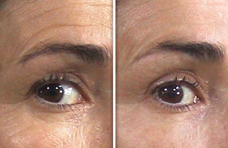 reduce fine lines and wrinkles around eyes in british columbia