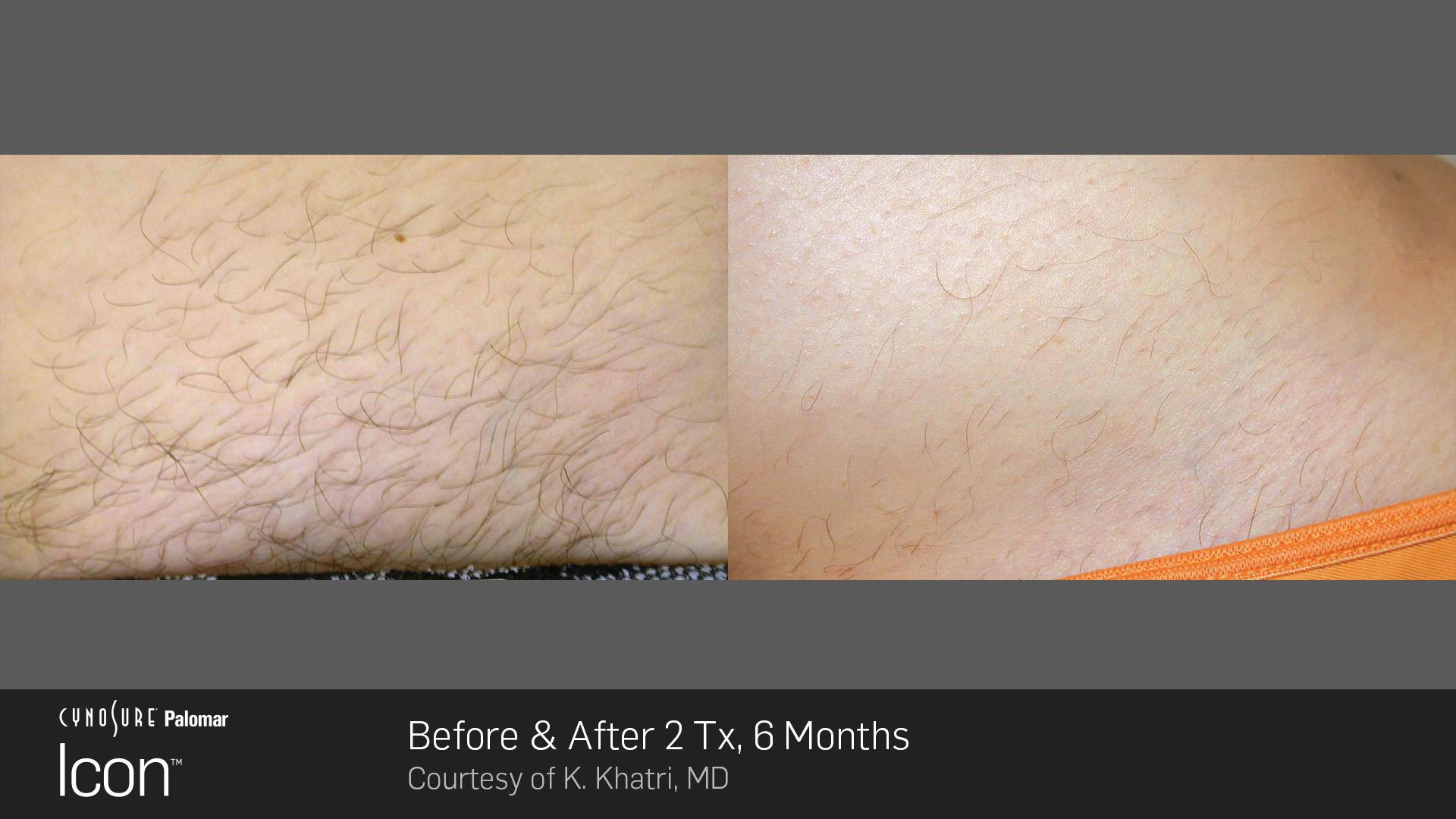 cynosure icon for laser hair removal in vancouver