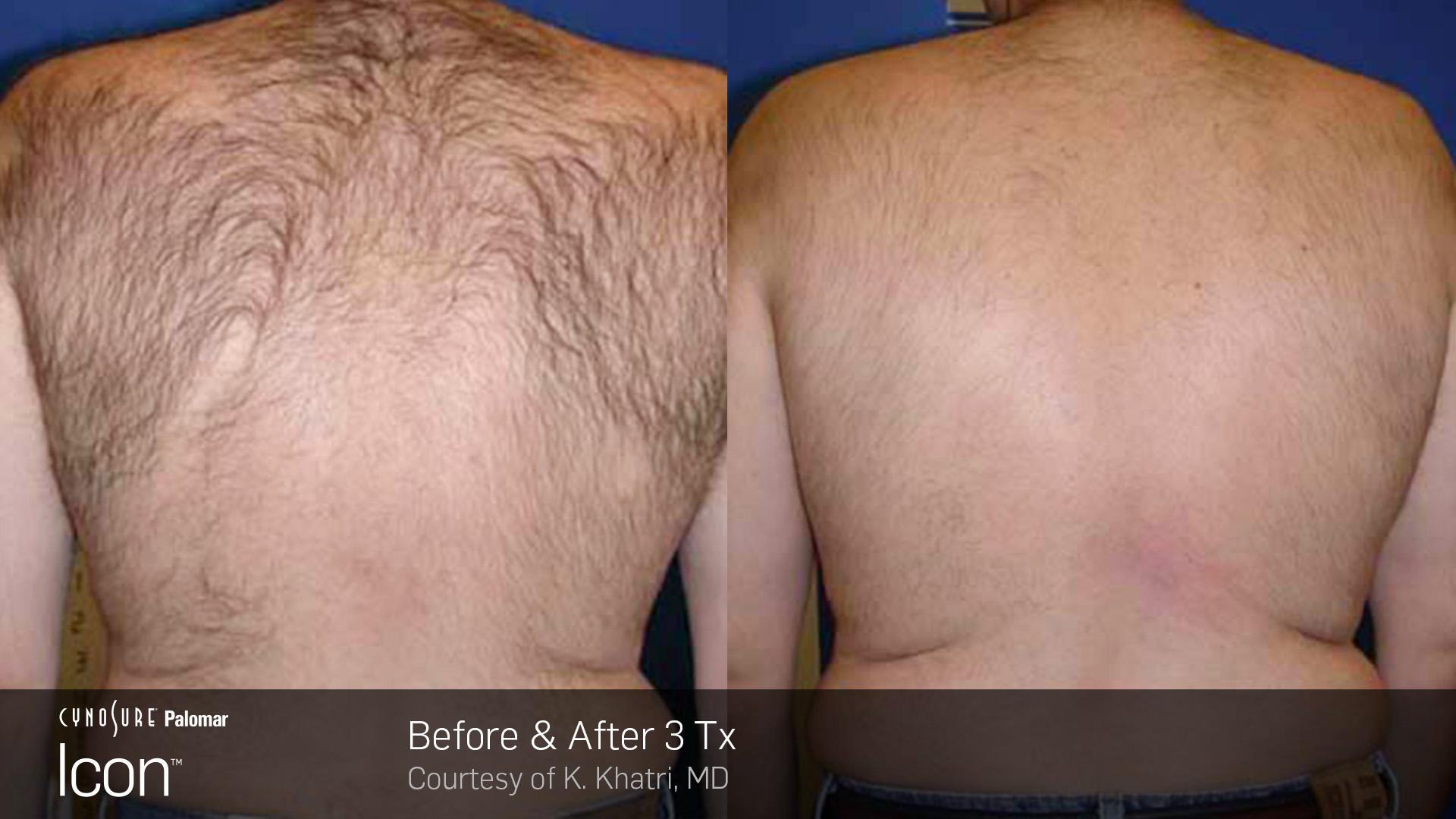 before and after laser hair removal with icon in west vancouver