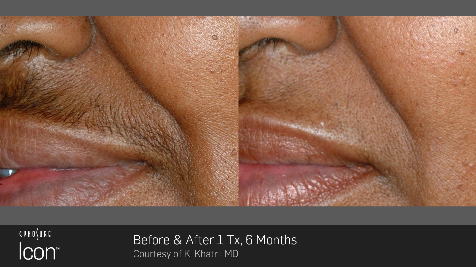 get laser for hair removal in british columbia icon cynosure