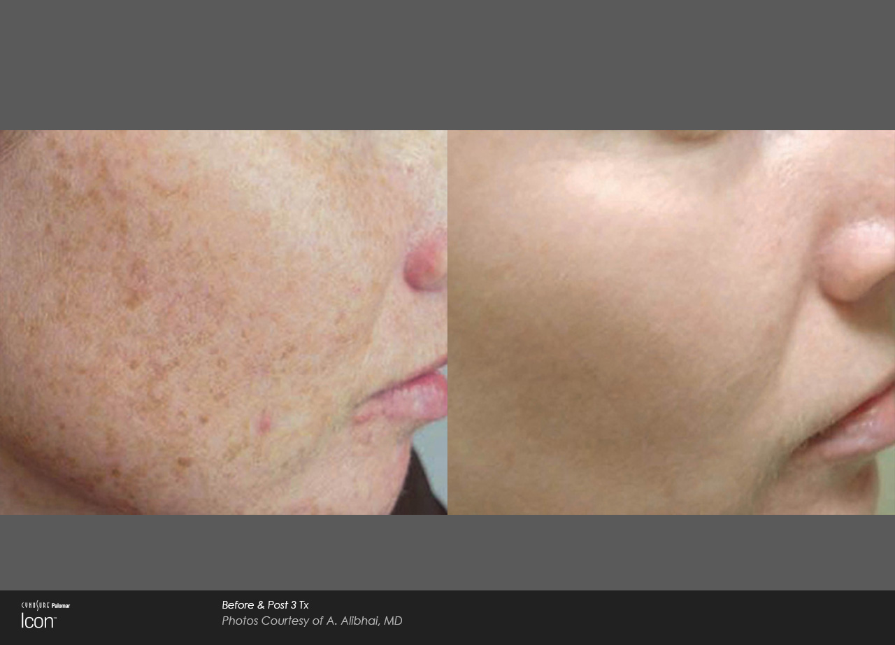 icon maxg ipl laser facial for blemish removal in vancouver