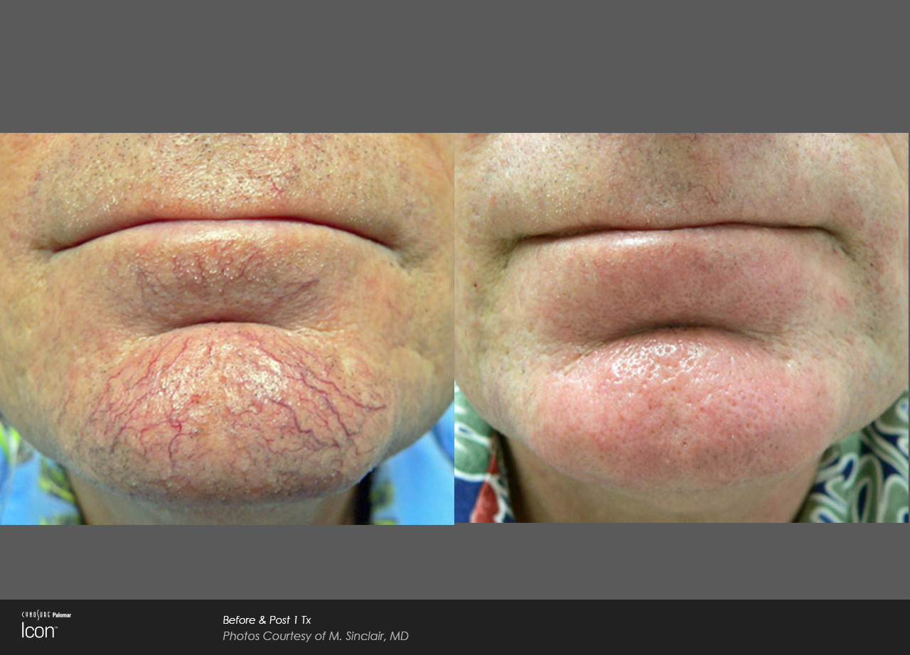 IPL laser facial for veins, wrinkles, and fine line removal in vancouver