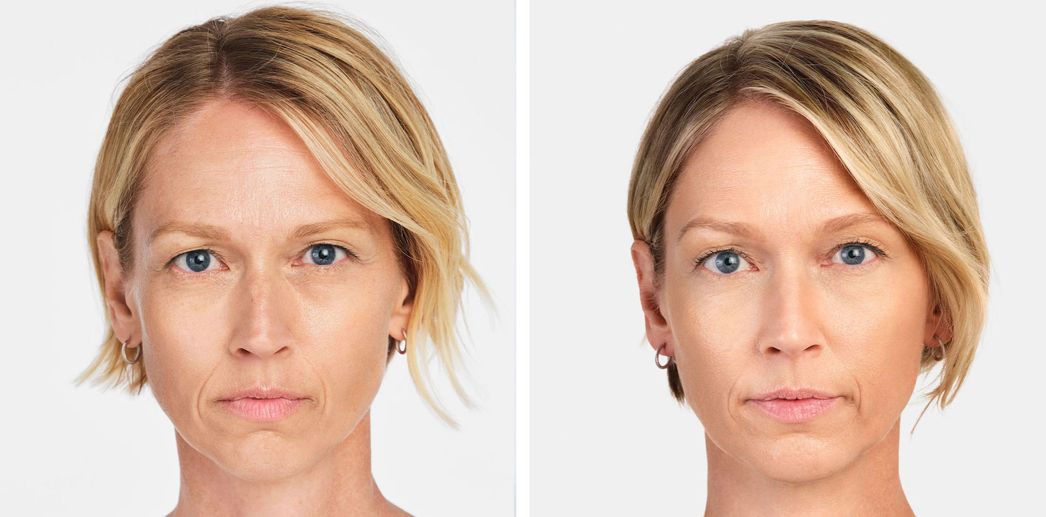 dermal facial fillers with radiesse in vancouver
