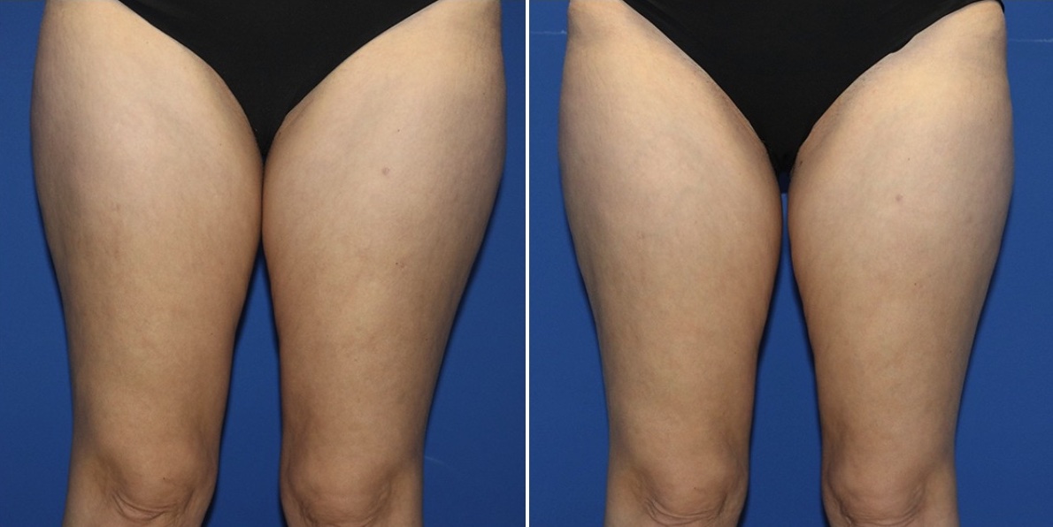 body contouring & fat reduction in vancouver