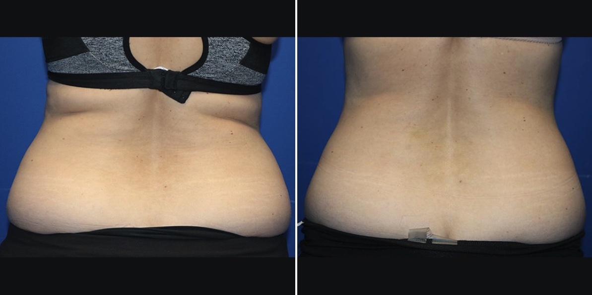 contour your body and reduce excess fat in vancouver