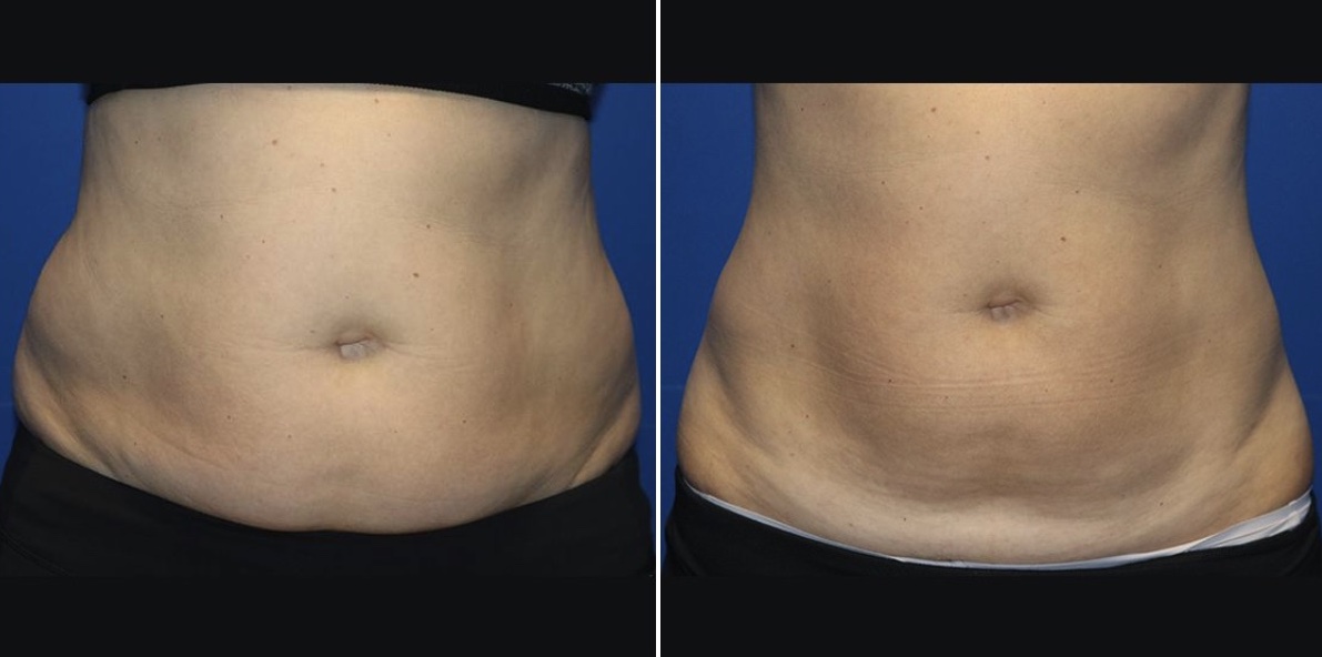 before & after fat reduction in british columbia