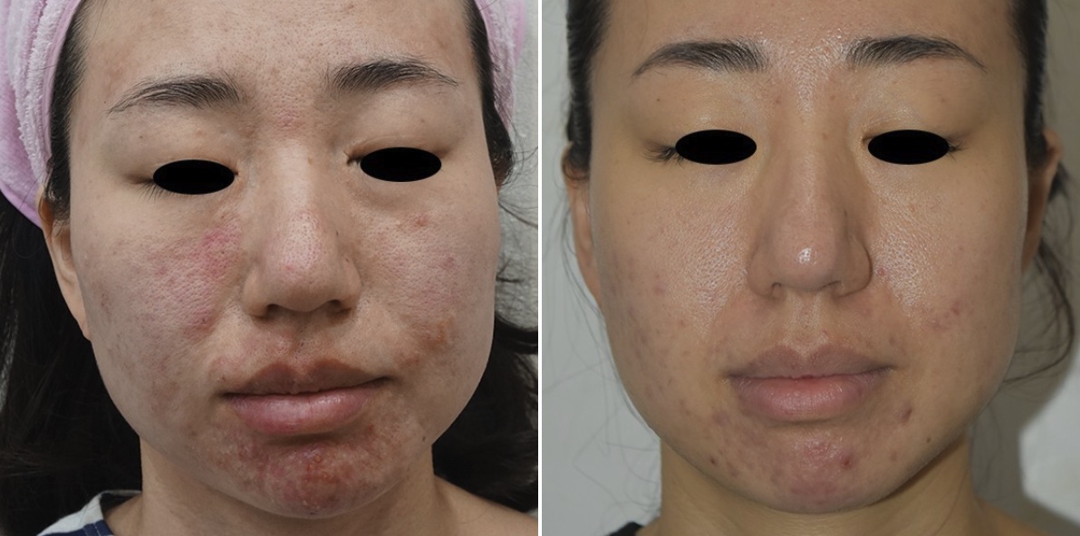 blemish & scar reduction in british columbia