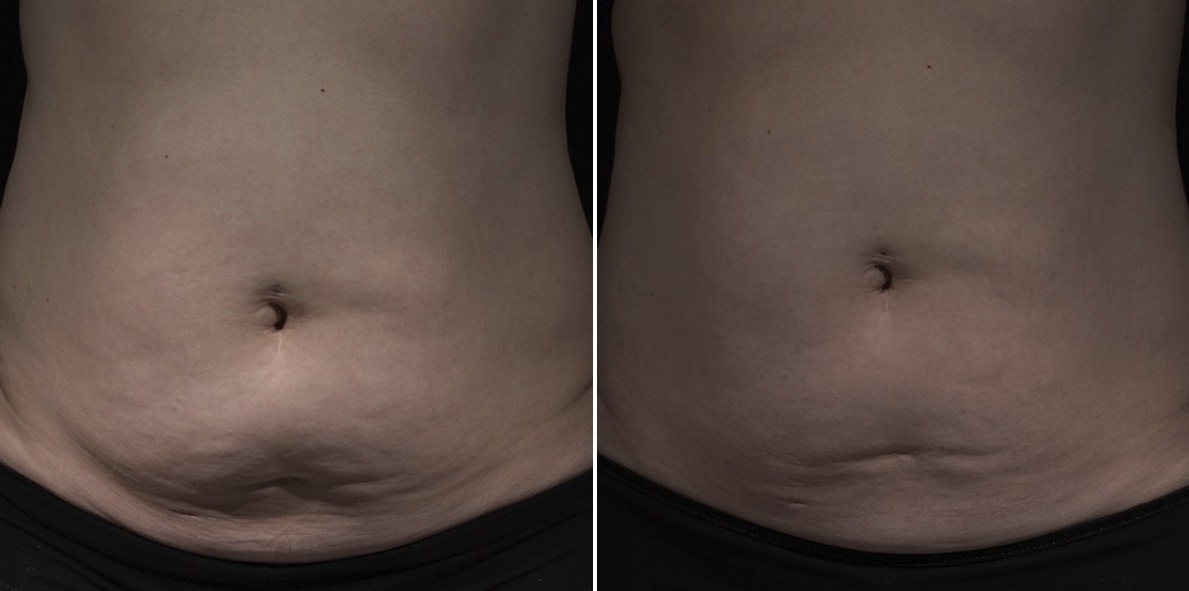 reduce scars and blemishes in west vancouver
