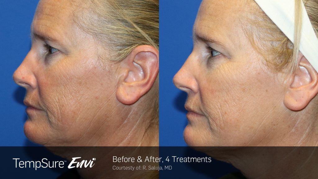 treatments to reduce fine lines & wrinkles in vancouver tempsure envi