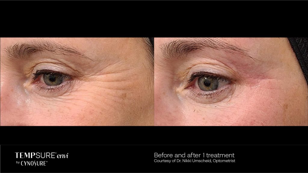 tempsure envi cynosure for wrinkle reduction in vancouver