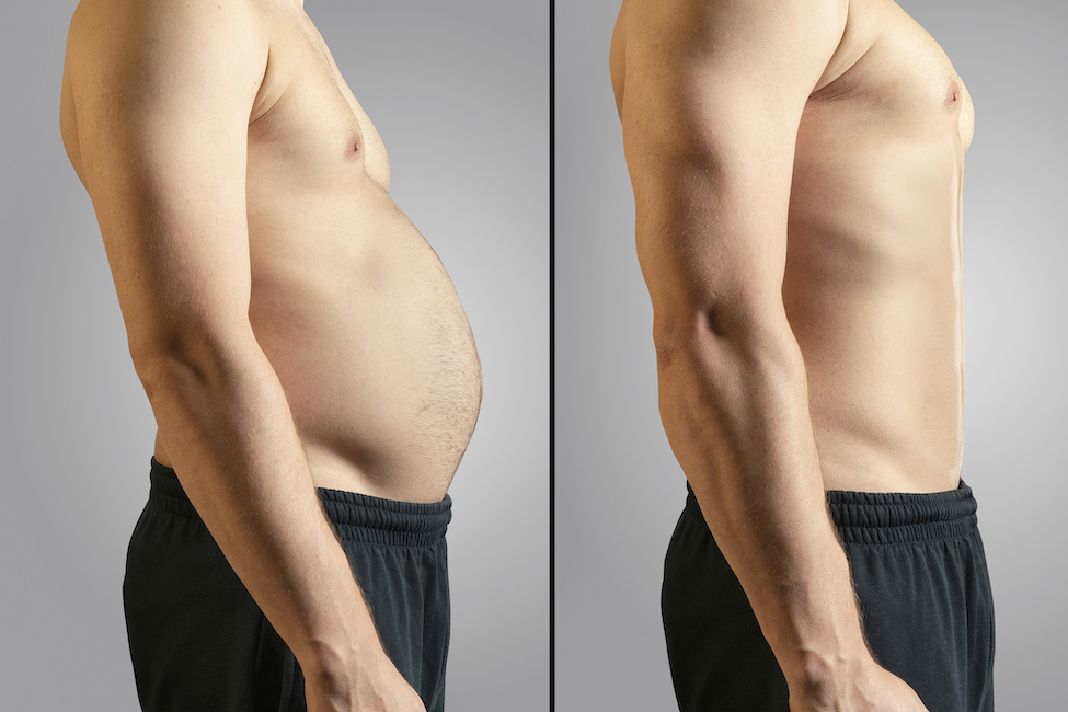 Before and after photos of real patients who have undergone body contouring and fat loss treatments at the clinic, highlighting the dramatic changes that can be achieved.