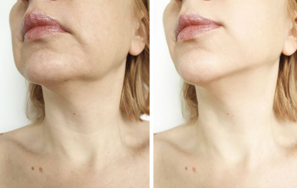 wrinkle skin smoothing treatment in vancouver