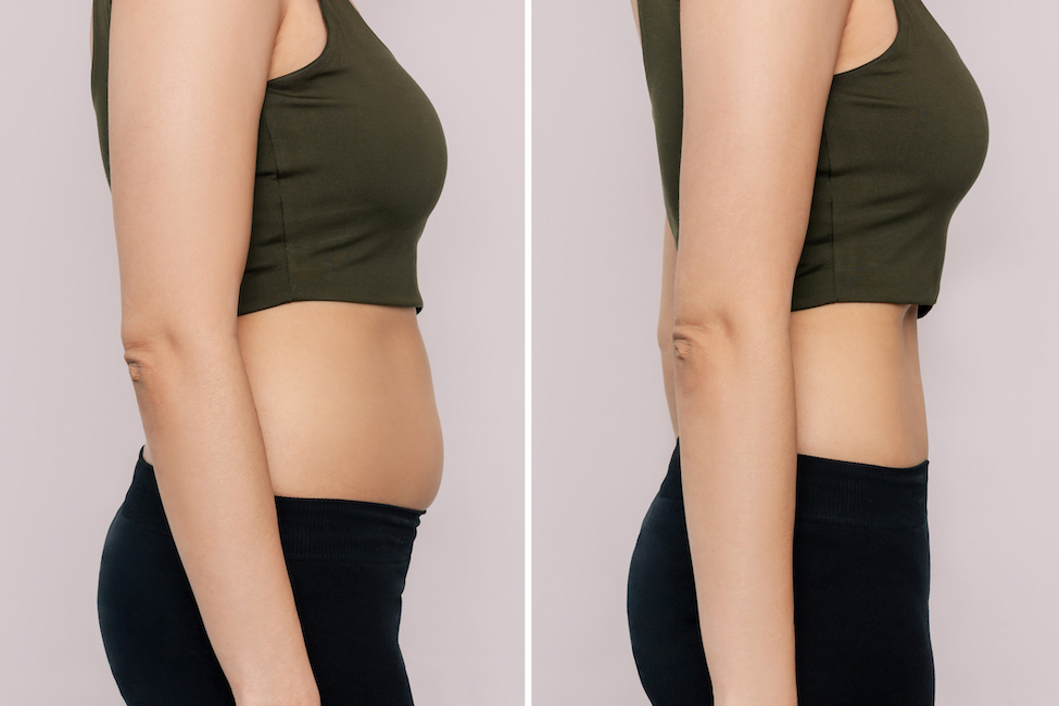 body-contouring fat loss results in vancouver