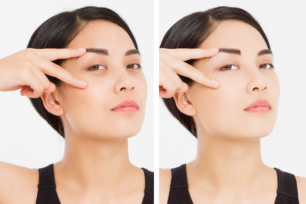 eyebrow rf wrinkle smoothing before and after in vancouver